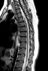 MRI Spine